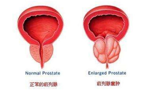 到底前列腺囊腫患者生活中要注意什